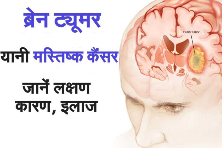ब्रेन ट्यूमर : सही समय पर इलाज ही मूलमंत्र है